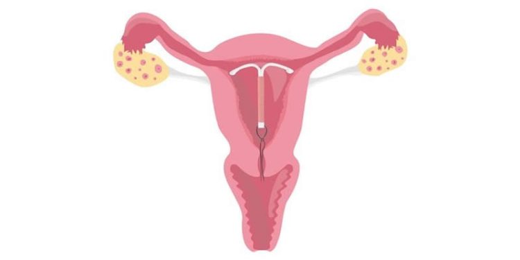 Spiral hakkında merak edilenler!