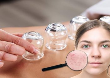 Hacamatın cilde ve saçlara faydaları nelerdir? Hacamat sivilceleri geçirir mi?