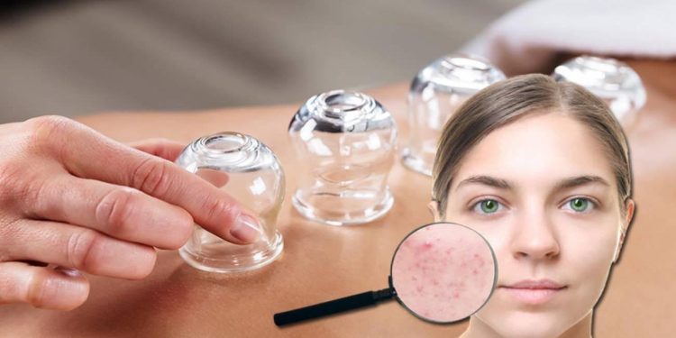 Hacamatın cilde ve saçlara faydaları nelerdir? Hacamat sivilceleri geçirir mi?